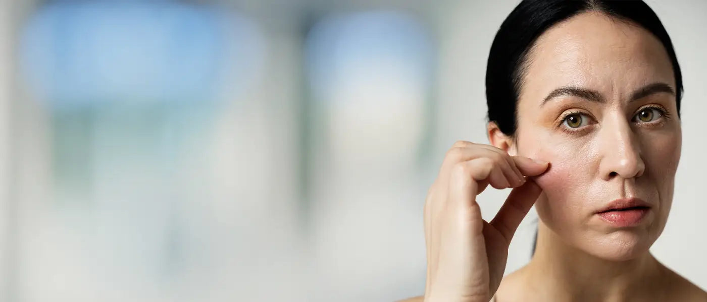 DRY/ DEHYDRATED SKIN